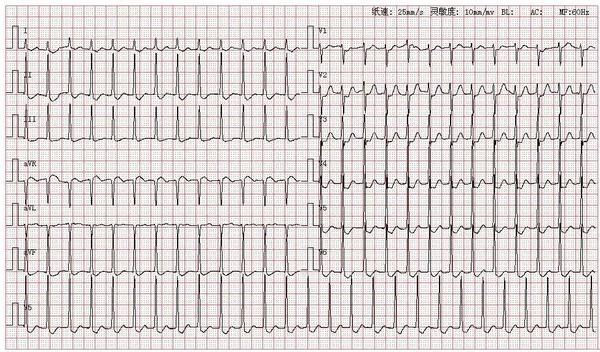 心电图图库丨室上性心动过速系列