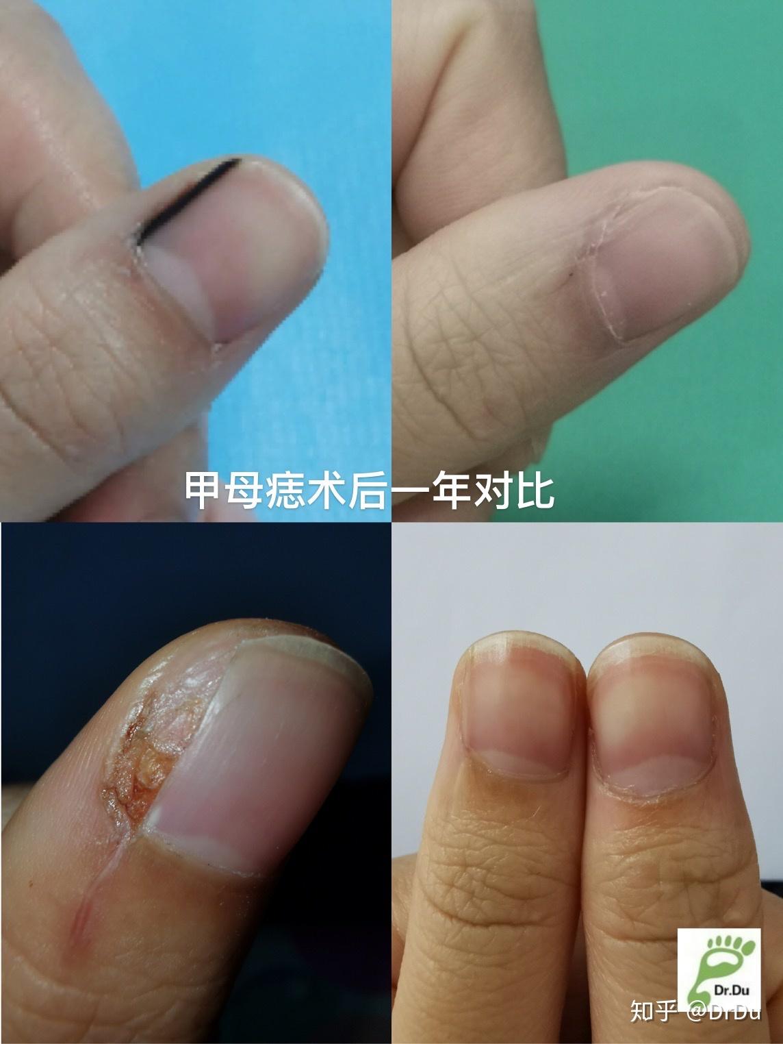 甲母痣切除手术