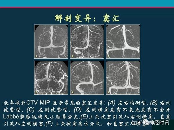 颅脑静脉系统cta解剖病理陷阱