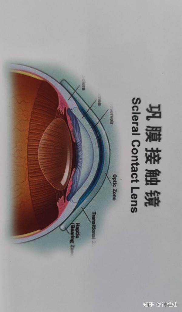 什么是巩膜镜