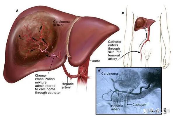 对于肝癌细胞,绝大部分的血供来自于肝动脉,因此选择将药物注入肝癌