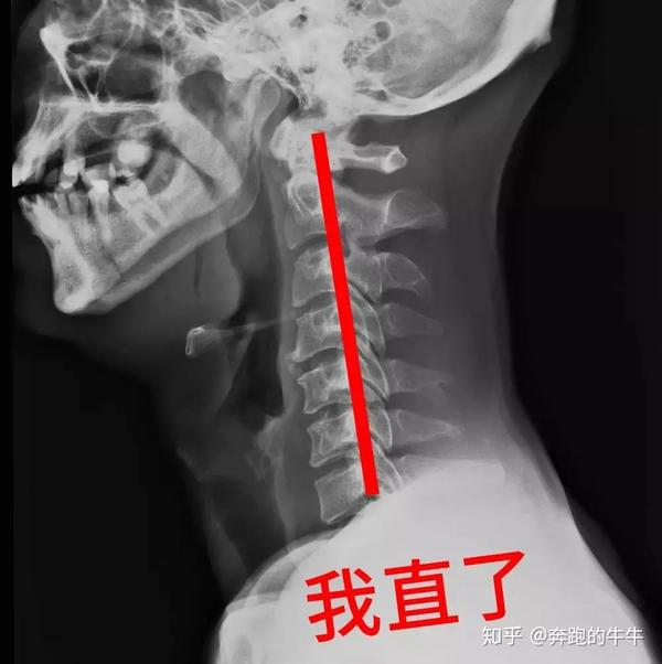 颈椎生理曲度变直!怎么