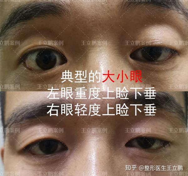 有些姑娘其实眼睛并不小,就因为上睑下垂看起来眼睛变小了,双睑提肌