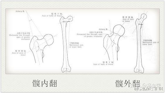 ○ 颈干角超过125°则为髋外翻,小于125°则为髋内翻.