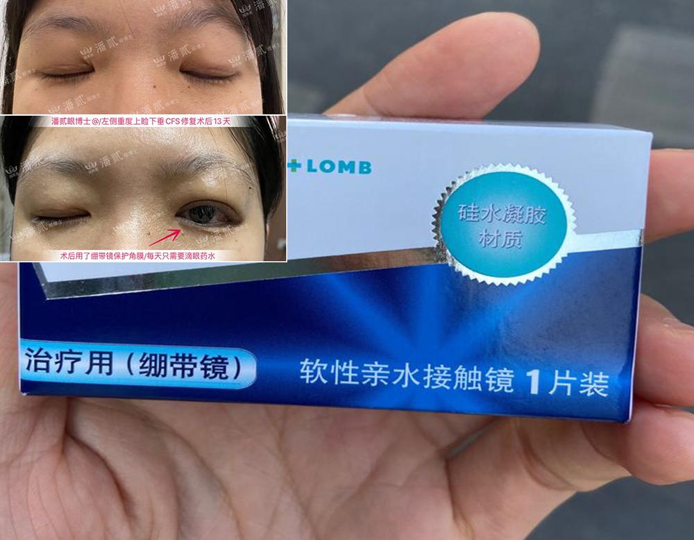 上睑下垂矫正术后保护眼睛健康的特殊隐形眼镜绷带镜的介绍与使用指南