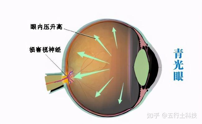 青光眼(glaucoma )是一组具有特征性视神经损害和视野缺损的眼病.