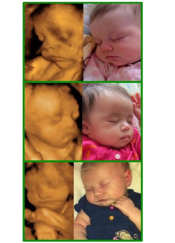 胎儿四维彩超照 vs 出生后的照片 惊人相似