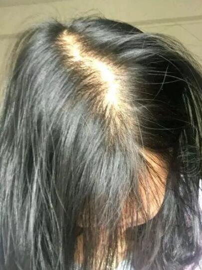 怎么治疗产后脱发比较好?