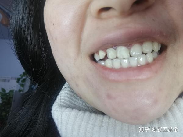 花了8500做了6个牙齿贴面困扰我20多年的大牙缝这样能解决了吧