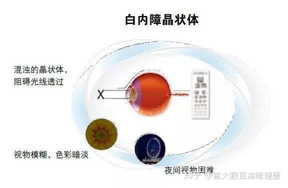 北京首大施玉英得了白内障有什么感觉白内障手术的最佳时间是什么时候