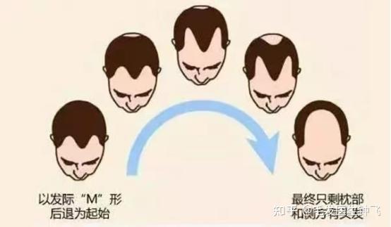 额角m型脱发怎么治疗