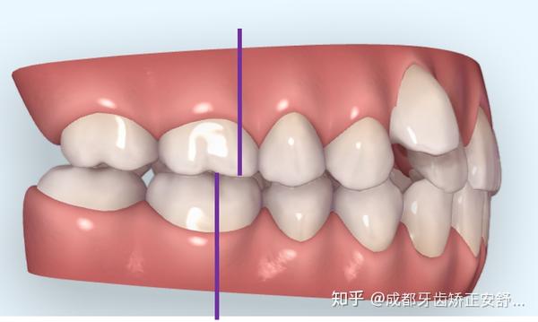 而单颗牙齿跑到了牙弓外面,后牙也就向前错位了,上下尖窝嵌合的关系被
