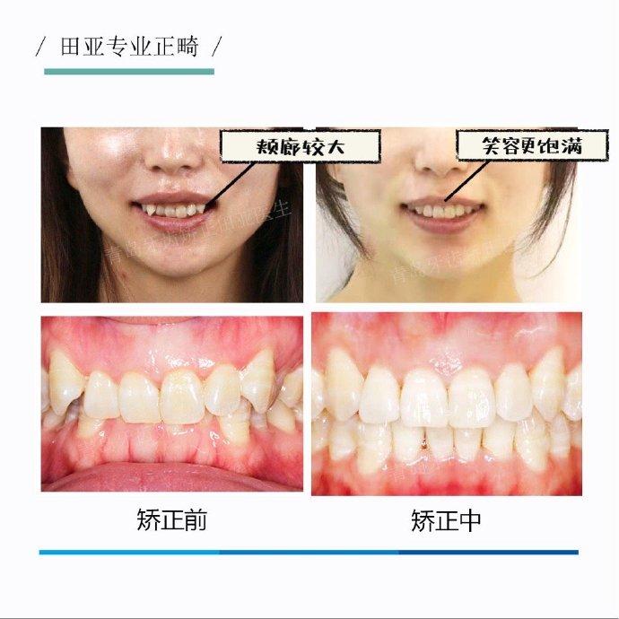 青岛牙齿矫正不拔牙矫正虎牙外突深覆合牙齿拥挤