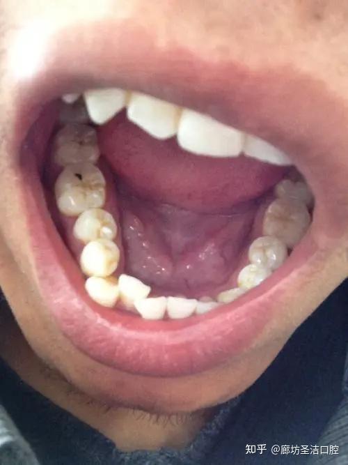 廊坊牙齿表面有黑点,不容忽视!