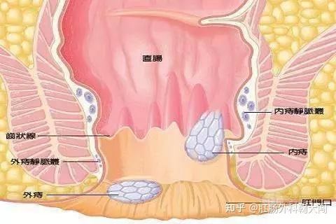 答案是肯定的!专家简介:鞠大闯,南方科技大学盐田医院肛肠科