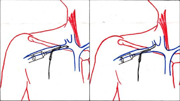 缺点:穿刺定位很困难,cvc是通过脖子或锁骨穿刺进入中心静脉,但是