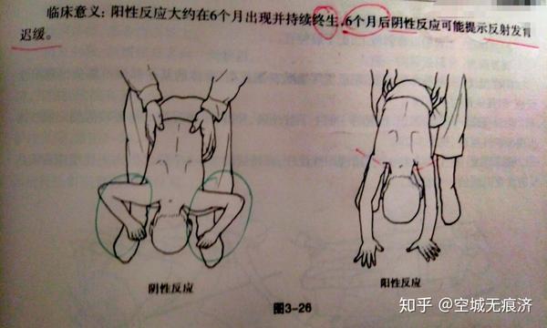 神经反射发育评定