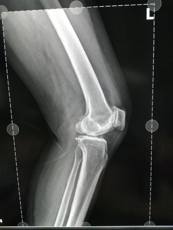 2,辅助检查: x光片示:双膝关节退行性变明显,两侧髌骨间隙变窄,右膝后
