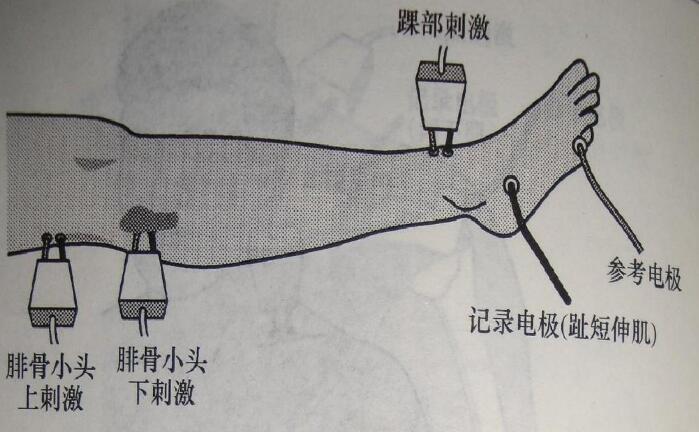 了该文章   什么原因引起末梢神经炎(多发性神经炎,多发性周围神经炎)