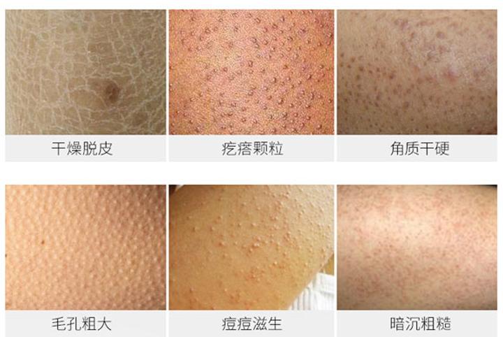 腿上严重的鸡皮肤怎么快速消除 再好的方法也不如产品