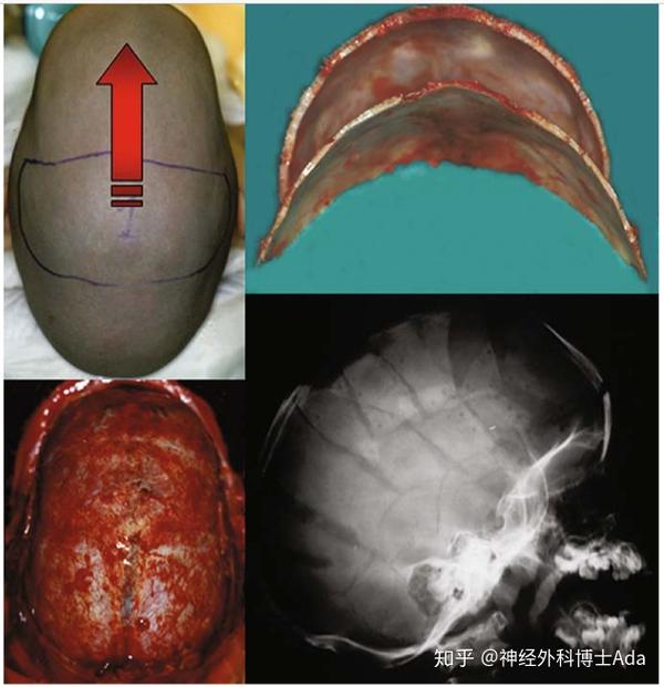 手术大师之di rocco教授解读先天性头颅畸形之舟状头的手术要点解析