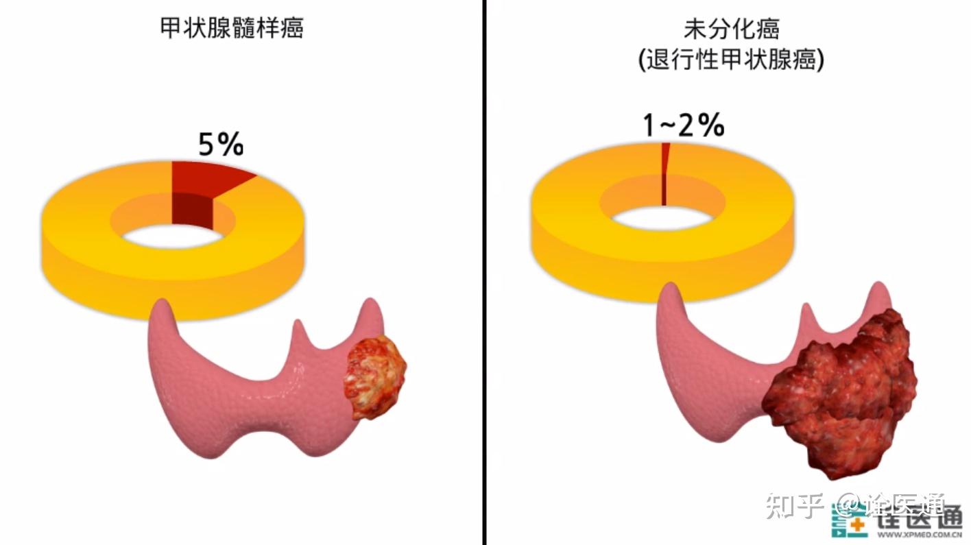 甲状腺未分化癌发病迅速,早期即发生浸润和转移,预后较差.