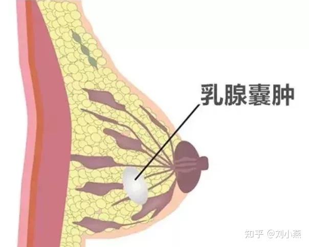 刘燕酿制:常见的几大乳房疾病,你知道多少?