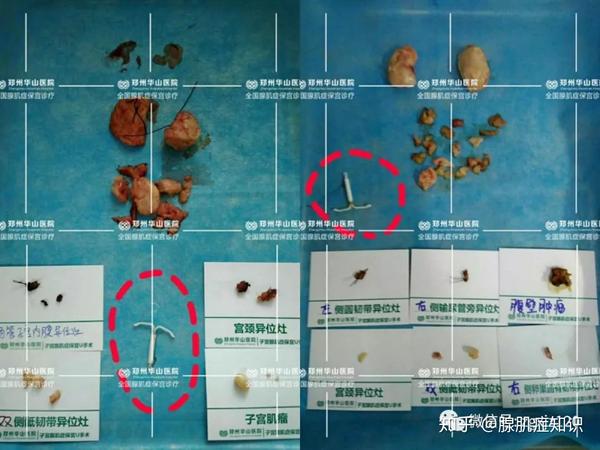 适合带曼月乐环的2个条件你符合吗