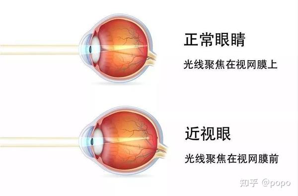 近视原理