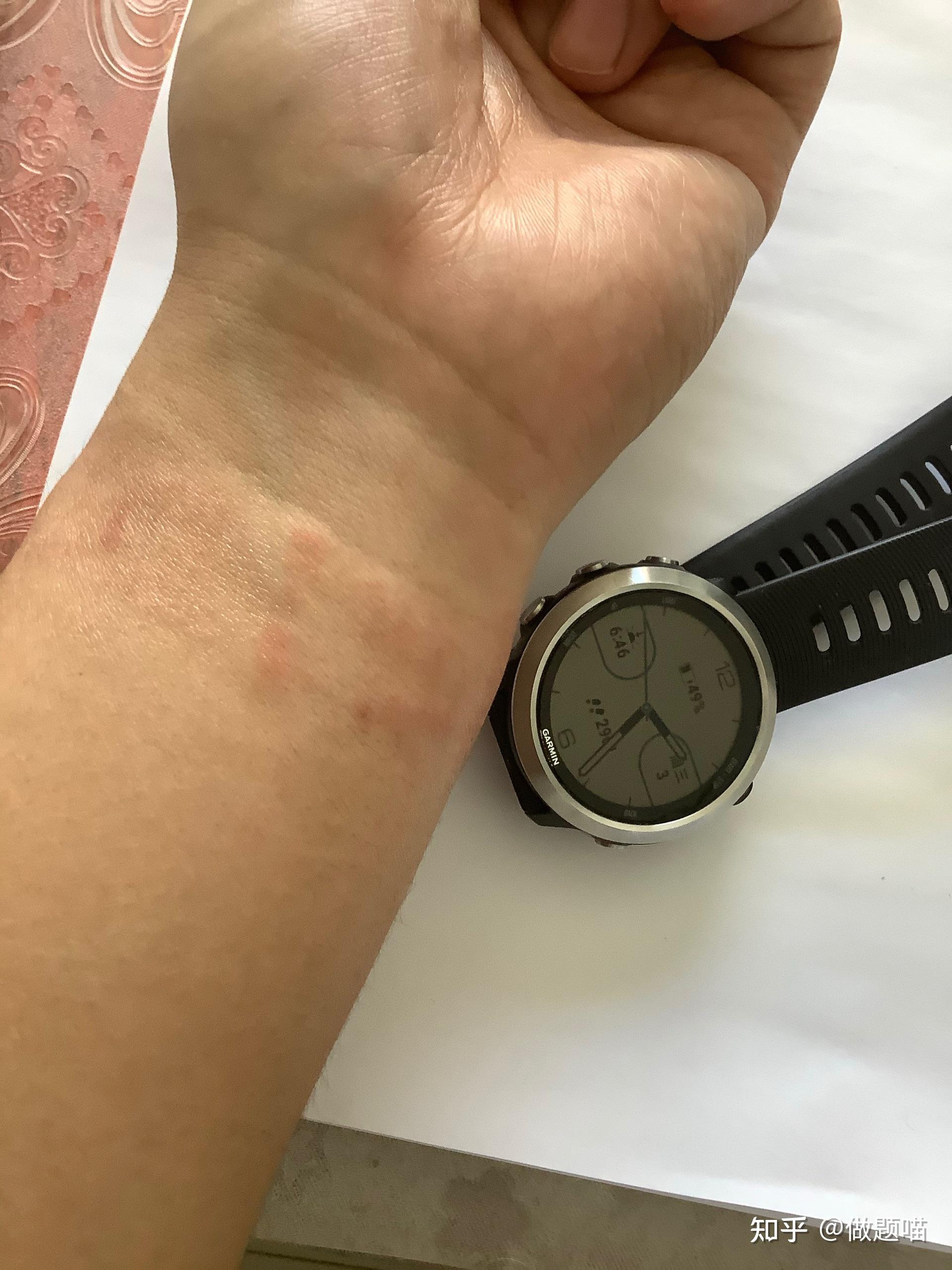 佳明945原装硅胶表带过敏怎么办