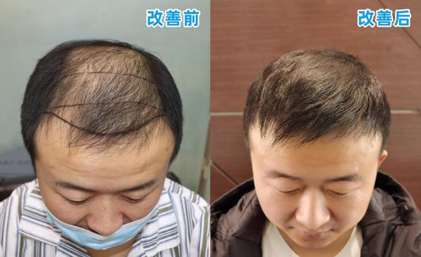 对于脂溢性脱发的恢复案例暂时更新到这里,大家对 于脱发,用药,植发有