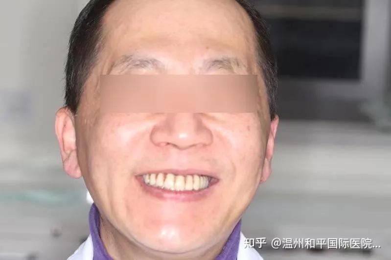 恒牙掉一颗少一颗,现代医学虽不能让掉落的恒牙再生,但人工种植牙能