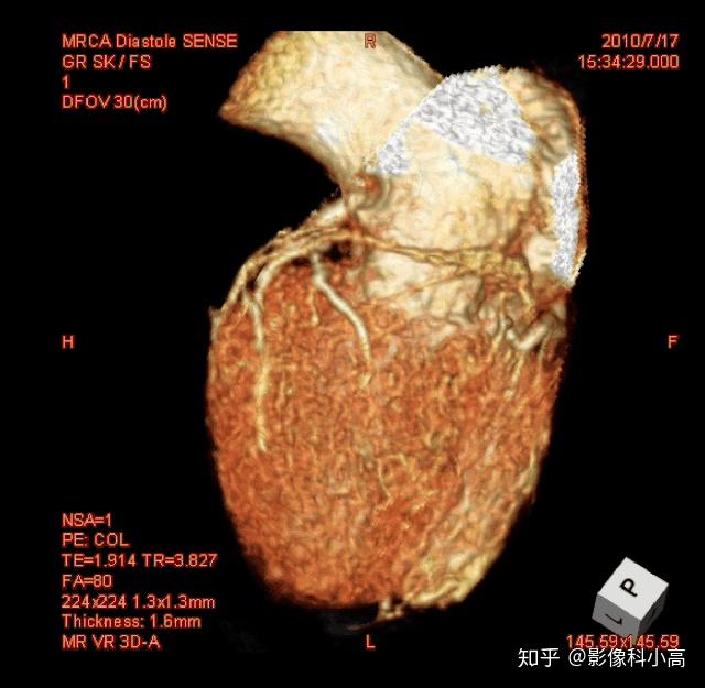 无论是心脏mri,还是冠脉mra检查,两者均无电离辐射且无需注射造影剂.