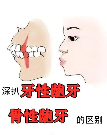 深扒牙性和骨性龅牙的区别