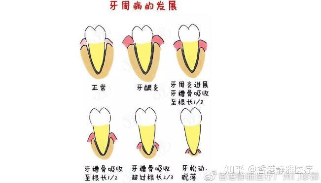 患了牙周炎会有哪些常见症状