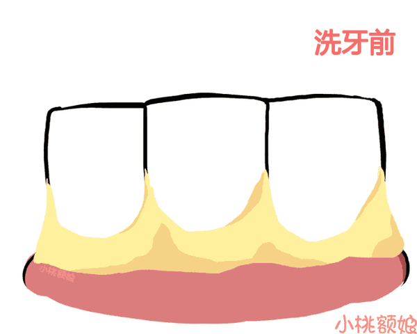 洗牙的过程是怎样的?洗牙后有哪些需要注意的?