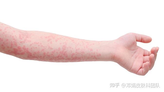 荨麻疹这类过敏性皮肤病的病因难道不是免疫力强吗为什么医生还会建议