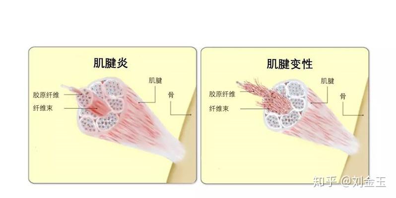 胫后肌腱炎怎么办