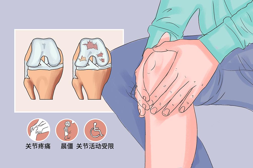 名人案例集膝骨关节炎半月板破裂软骨损伤拯救无数运动员职业生涯的干