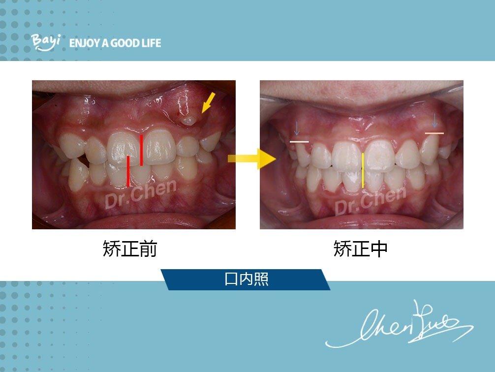 重庆牙齿矫正虎牙被误认成多生牙替牙期的早期干预很重要