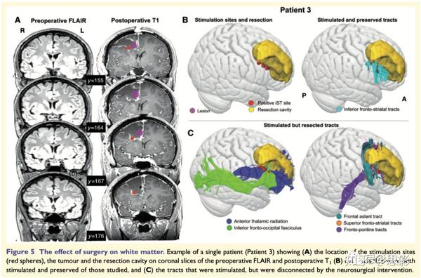 手术对白质的影响 结果: 肿瘤位置:最大重叠区域(n=12)位于右额叶和