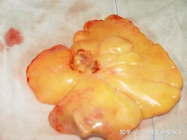 脂肪瘤会不会变成脂肪肉瘤