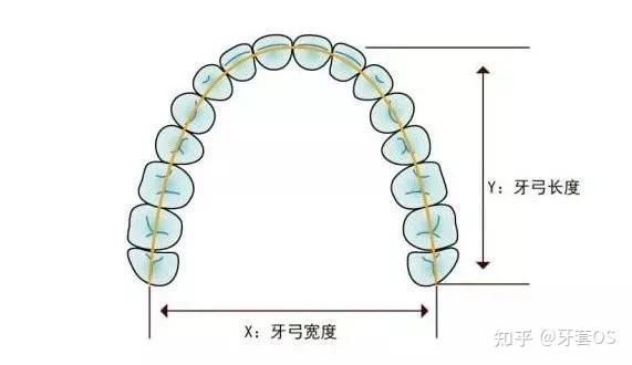 牙齿矫正中扩弓会把脸扩大?成都牙科医生为你解答