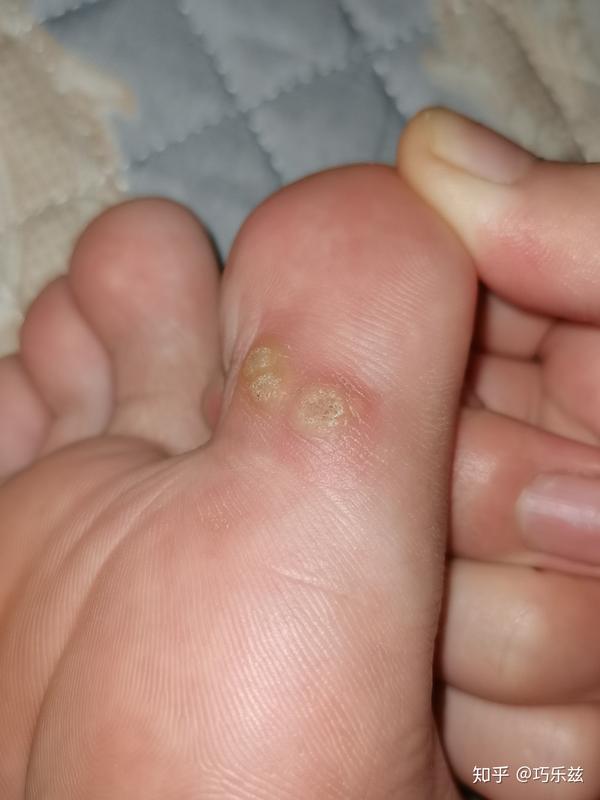 大家给我分析一下脚趾头长的是不是老茧或者是鸡眼
