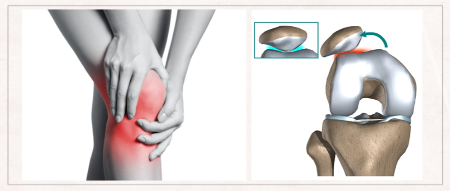 锐博康复膝盖疼痛髌骨出轨与股四头肌的那些事儿