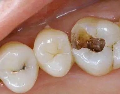 【科普】牙齿剧烈疼痛可能是牙髓炎,需要及时治疗!
