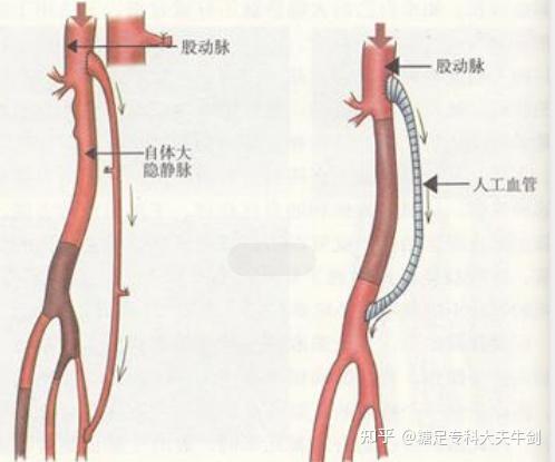 糖尿病足下肢动脉闭塞能不能做血管搭桥疏通?