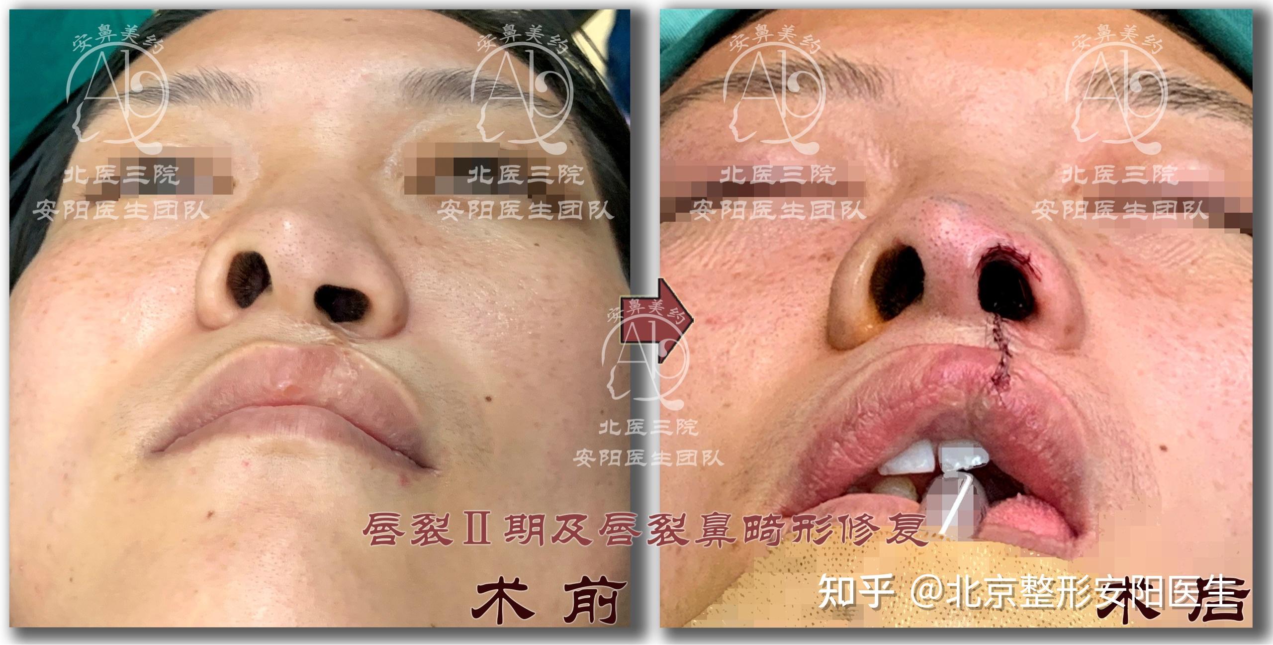 为这些患儿进行唇裂二期修复及唇裂鼻畸形修复术,术后使患儿鼻孔