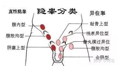 据报道,早产儿隐睾的发病率为30%,新生儿为4%,1岁时为0.