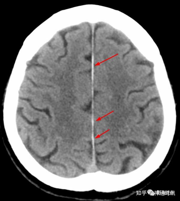 间断性的大脑镰不完全线状钙化(红箭,同样呈边缘光滑,居中改变.